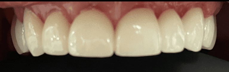 A-Stunning-Smile-Makeover-After-Image