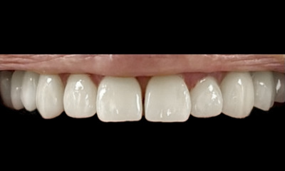 After treatment - Smile makeover