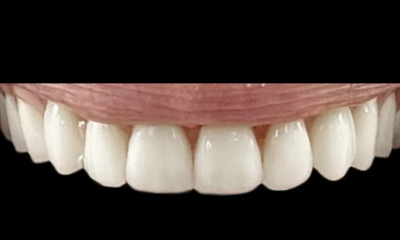 After treatment - Smile makeover