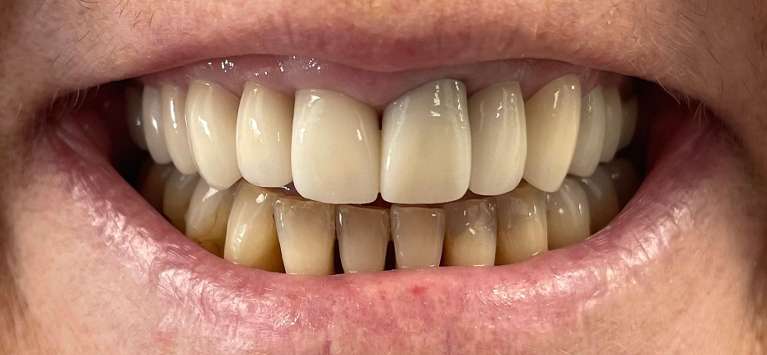 A patient with new crowns in Tampa, FL
