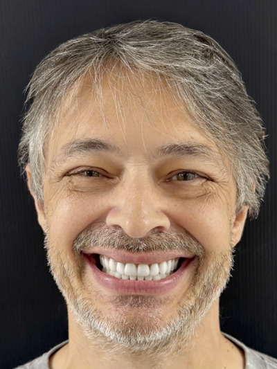 After treatment - Smile makeover