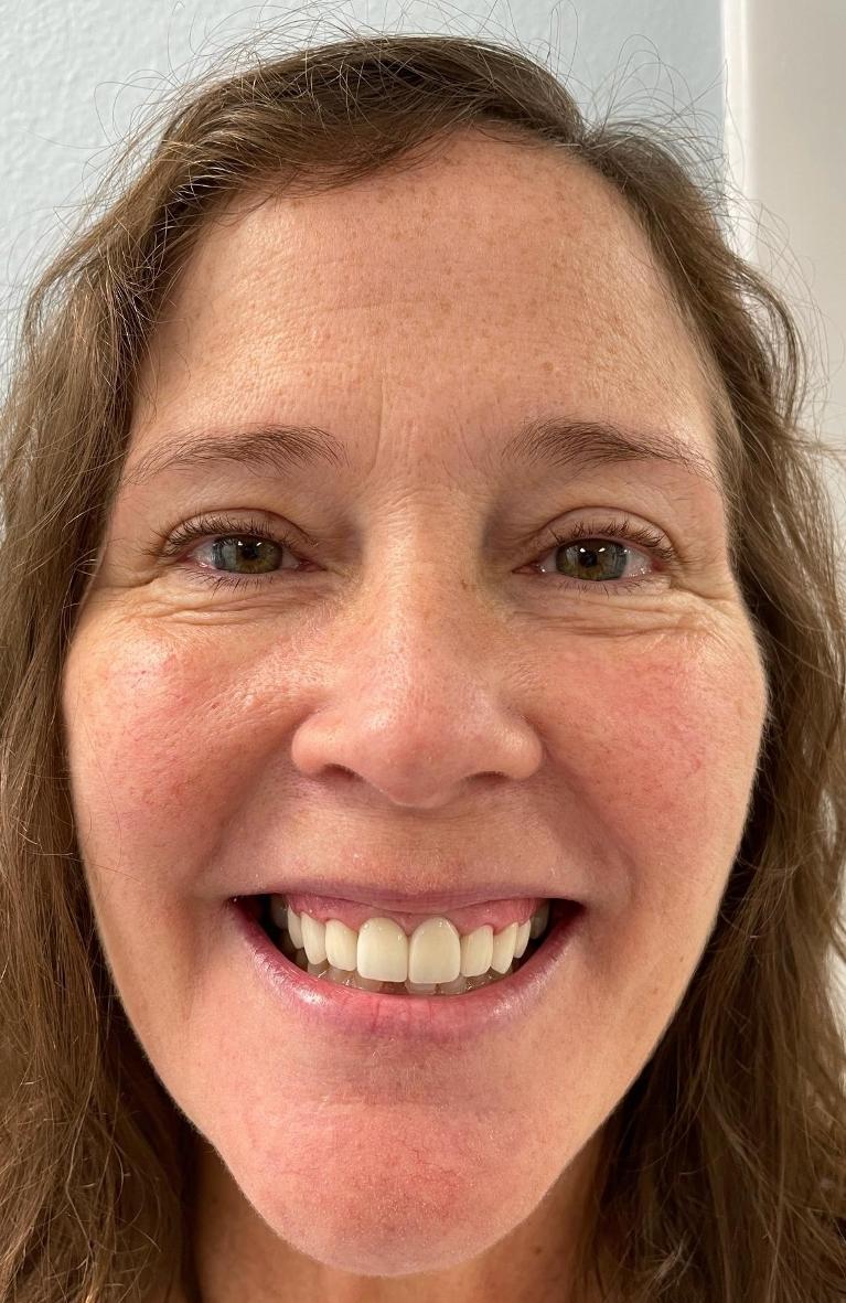 Patient with new porcelain crowns in tampa