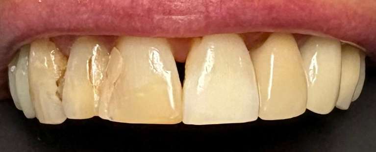 A-New-Beautiful-Smile-Before-Image