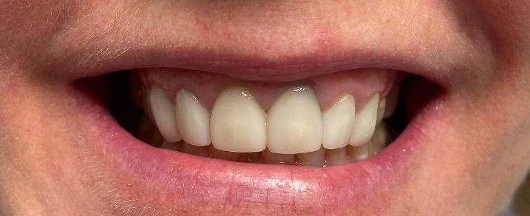 Tampa dental patient with old veneers