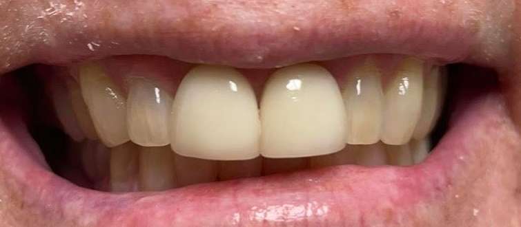 A patient with old crowns in Tampa FL