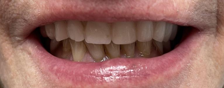 Smile-Makeover-with-a-new-Denture-Before-Image