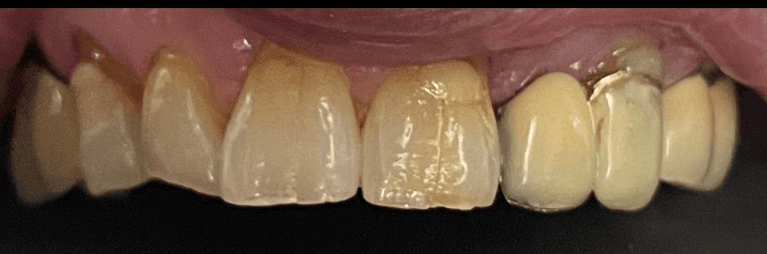 A-Stunning-Smile-Makeover-Before-Image
