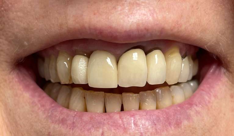 A patient with old crowns in