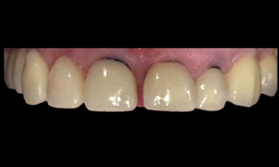 Before treatment - Smile makeover