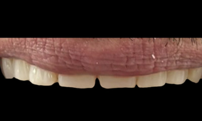 Before treatment - Smile makeover