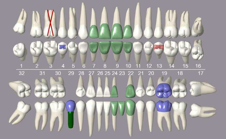 3D Tooth Charting in Tampa, Fl