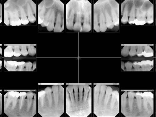 Full-mouth digital X-ray series showing detailed views of teeth and roots for comprehensive dental diagnosis